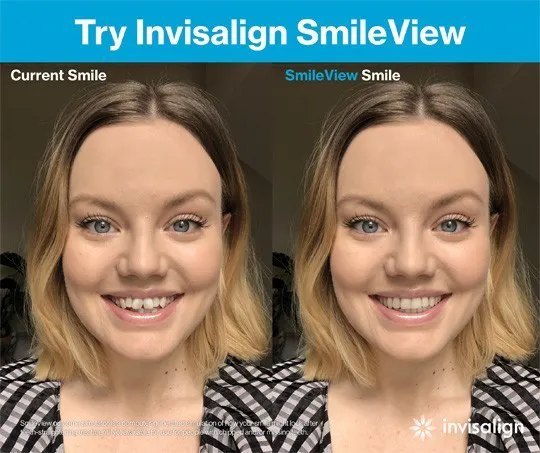 Ejemplo de simulación Invisalign SmileView: a la izquierda la sonrisa actual y a la derecha la sonrisa simulada con los dientes alineados